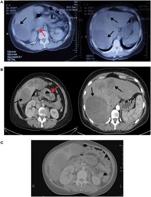 Hepatoid Adenocarcinoma of the Stomach: A Challenging Diagnostic and Therapeutic Disease through a Case Report and Review of the Literature